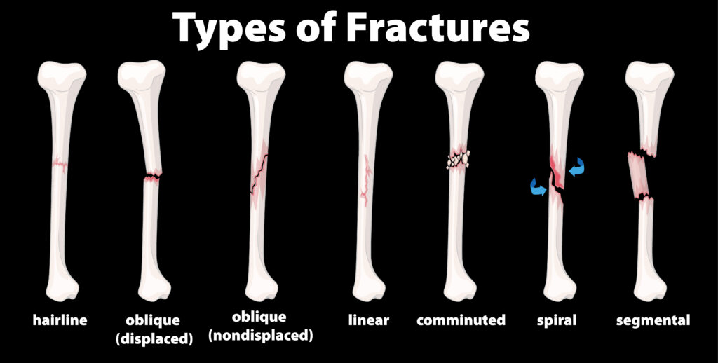 Bone Fracture