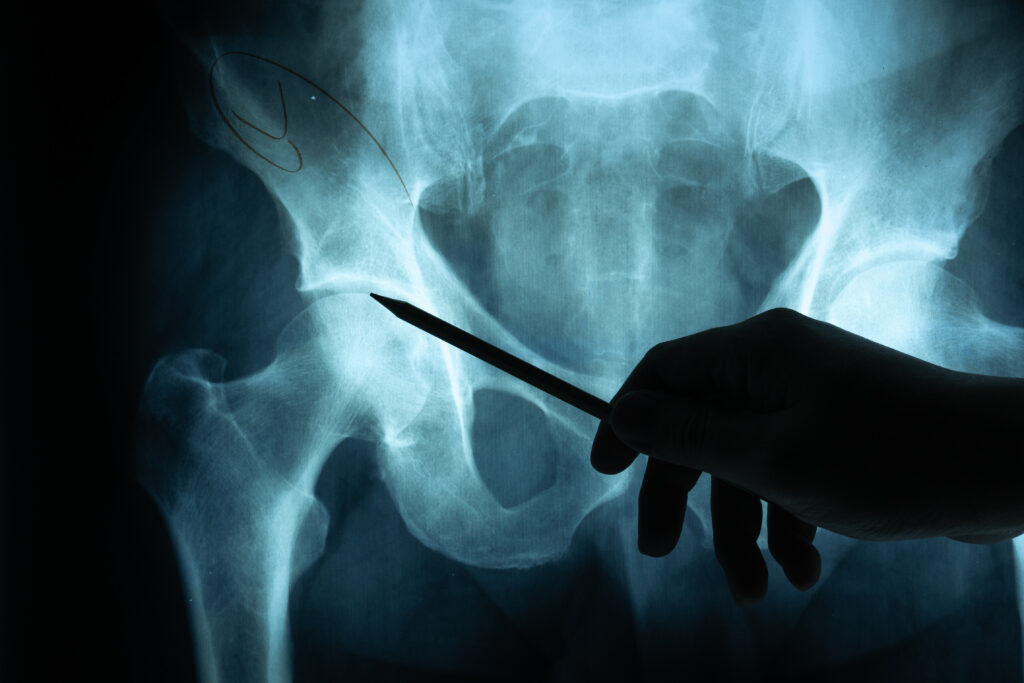 Hip Replacement Surgery
