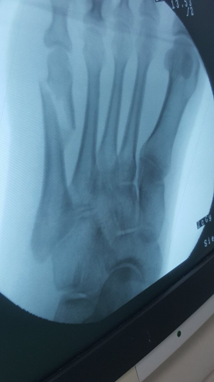 Fracture Fixation