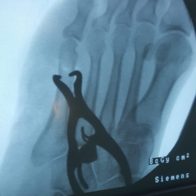 Fracture Fixation