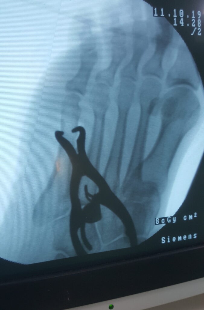 Fracture Fixation