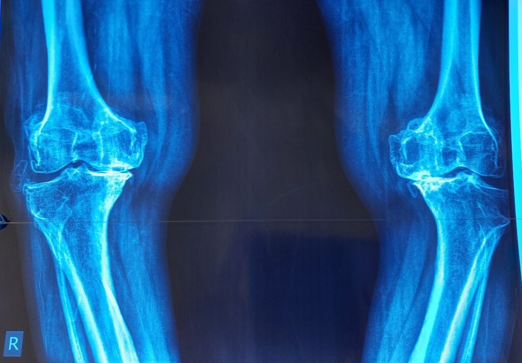 Total Knee Replacement